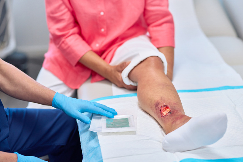 L'infermiera esegue una cura sulla gamba con il Cutimed Sorbion L'infermiera esegue una cura sulla gamba con il Cutimed Sorbion